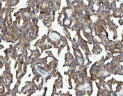IHC staining of FFPE human renal cancer with Elongation Factor 2 antibody. HIER: boil tissue sections in pH8 EDTA for 20 min and allow to cool before testing.