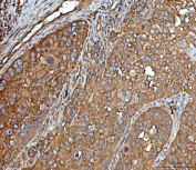 IHC staining of FFPE human laryngeal squamous cell carcinoma tissue with Elongation Factor 2 antibody. HIER: boil tissue sections in pH8 EDTA for 20 min and allow to cool before testing.