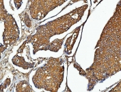 IHC staining of FFPE human breast cancer tissue with Elongation Factor 2 antibody. HIER: boil tissue sections in pH8 EDTA for 20 min and allow to cool before testing.
