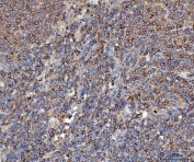 IHC staining of FFPE human lymphoma with Elongation Factor 2 antibody. HIER: boil tissue sections in pH8 EDTA for 20 min and allow to cool before testing.