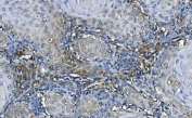 IHC staining of FFPE human esophageal squamous cancer with GABARAP antibody. HIER: boil tissue sections in pH8 EDTA for 20 min and allow to cool before testing.