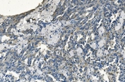 IHC staining of FFPE human renal cancer with GABARAP antibody. HIER: boil tissue sections in pH8 EDTA for 20 min and allow to cool before testing.