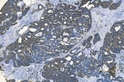 IHC staining of FFPE human ovarian cancer with GABARAP antibody. HIER: boil tissue sections in pH8 EDTA for 20 min and allow to cool before testing.