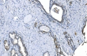IHC staining of FFPE human prostate cancer with GCHFR antibody. HIER: boil tissue sections in pH8 EDTA for 20 min and allow to cool before testing.