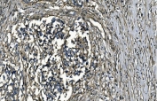 IHC staining of FFPE human bladder cancer with GNG7 antibody. HIER: boil tissue sections in pH8 EDTA for 20 min and allow to cool before testing.