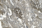 IHC staining of FFPE human renal carcinoma with GNG7 antibody. HIER: boil tissue sections in pH8 EDTA for 20 min and allow to cool before testing.