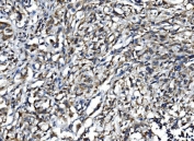 IHC staining of FFPE human B-lymphocyte tumor with Interleukin 15 antibody. HIER: boil tissue sections in pH8 EDTA for 20 min and allow to cool before testing.