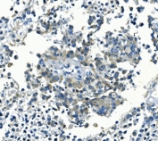 IHC staining of FFPE human pancreatic cancer with KCNJ8 antibody. HIER: boil tissue sections in pH8 EDTA for 20 min and allow to cool before testing.