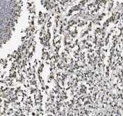 IHC staining of FFPE human pancreatic cancer with METTL1 antibody. HIER: boil tissue sections in pH8 EDTA for 20 min and allow to cool before testing.