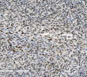 IHC staining of FFPE human skin cancer with METTL1 antibody. HIER: boil tissue sections in pH8 EDTA for 20 min and allow to cool before testing.