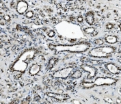 IHC staining of FFPE human breast cancer with METTL1 antibody. HIER: boil tissue sections in pH8 EDTA for 20 min and allow to cool before testing.