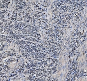 IHC staining of FFPE human gastric cancer with METTL1 antibody. HIER: boil tissue sections in pH8 EDTA for 20 min and allow to cool before testing.