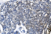 IHC staining of FFPE human ovarian cancer with METTL3 antibody. HIER: boil tissue sections in pH8 EDTA for 20 min and allow to cool before testing.