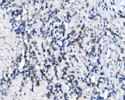 IHC staining of FFPE human gastric cancer with METTL3 antibody. HIER: boil tissue sections in pH8 EDTA for 20 min and allow to cool before testing.