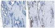 IHC staining of FFPE human breast cancer negative control (left) and with METTL14 antibody (right). HIER: boil tissue sections in pH8 EDTA for 20 min and allow to cool before testing.