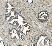 IHC staining of FFPE human prostate cancer with NDUFB10 antibody. HIER: boil tissue sections in pH8 EDTA for 20 min and allow to cool before testing.