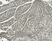 IHC staining of FFPE human liver cancer with NDUFB10 antibody. HIER: boil tissue sections in pH8 EDTA for 20 min and allow to cool before testing.