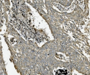 IHC staining of FFPE human lung cancer with NDUFB10 antibody. HIER: boil tissue sections in pH8 EDTA for 20 min and allow to cool before testing.