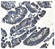IHC staining of FFPE human rectal cancer with PCBP1 antibody. HIER: boil tissue sections in pH8 EDTA for 20 min and allow to cool before testing.