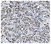 IHC staining of FFPE human breast cancer with PCBP1 antibody. HIER: boil tissue sections in pH8 EDTA for 20 min and allow to cool before testing.
