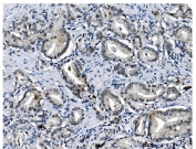 IHC staining of FFPE human prostate cancer with PCBP1 antibody. HIER: boil tissue sections in pH8 EDTA for 20 min and allow to cool before testing.
