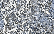 IHC staining of FFPE human pancreatic cancer with PCBP2 antibody. HIER: boil tissue sections in pH8 EDTA for 20 min and allow to cool before testing.