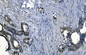 IHC staining of FFPE human rectal cancer with PCBP2 antibody. HIER: boil tissue sections in pH8 EDTA for 20 min and allow to cool before testing.