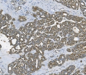 IHC staining of FFPE human ovarian cancer with RAB1B antibody. HIER: boil tissue sections in pH8 EDTA for 20 min and allow to cool before testing.