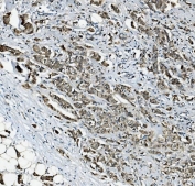 IHC staining of FFPE human breast cancer with RAB1B antibody. HIER: boil tissue sections in pH8 EDTA for 20 min and allow to cool before testing.