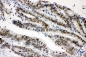 IHC staining of FFPE human intestinal cancer with SUMO1 antibody. HIER: boil tissue sections in pH8 EDTA for 20 min and allow to cool before testing.