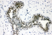 IHC staining of FFPE human breast cancer with SUMO1 antibody. HIER: boil tissue sections in pH8 EDTA for 20 min and allow to cool before testing.