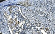 IHC staining of FFPE human bladder cancer with UBE2D1/2/3/4 antibody. HIER: boil tissue sections in pH8 EDTA for 20 min and allow to cool before testing.