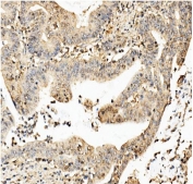 IHC staining of FFPE human rectal cancer with CKAP5 antibody. HIER: boil tissue sections in pH8 EDTA for 20 min and allow to cool before testing.