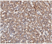 IHC staining of FFPE human liver cancer with CKAP5 antibody. HIER: boil tissue sections in pH8 EDTA for 20 min and allow to cool before testing.