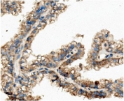 IHC staining of FFPE human renal cancer with CKAP5 antibody. HIER: boil tissue sections in pH8 EDTA for 20 min and allow to cool before testing.