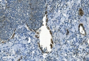 IHC staining of FFPE human lung cancer with IDH2 antibody. HIER: boil tissue sections in pH8 EDTA for 20 min and allow to cool before testing.