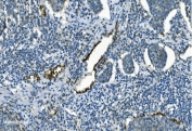 IHC staining of FFPE human lung cancer with IDH2 antibody. HIER: boil tissue sections in pH8 EDTA for 20 min and allow to cool before testing.