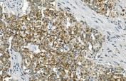 IHC staining of FFPE human renal carcinoma with IDH2 antibody. HIER: boil tissue sections in pH8 EDTA for 20 min and allow to cool before testing.