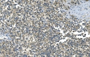 IHC staining of FFPE human testicular cancer with IDH2 antibody. HIER: boil tissue sections in pH8 EDTA for 20 min and allow to cool before testing.