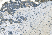 IHC staining of FFPE human ovarian cancer with IDH2 antibody. HIER: boil tissue sections in pH8 EDTA for 20 min and allow to cool before testing.