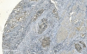 IHC staining of FFPE human bladder cancer with IDH2 antibody. HIER: boil tissue sections in pH8 EDTA for 20 min and allow to cool before testing.