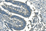 IHC staining of FFPE human rectal cancer with IDH2 antibody. HIER: boil tissue sections in pH8 EDTA for 20 min and allow to cool before testing.