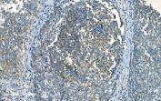 IHC staining of FFPE human melanoma with IDH2 antibody. HIER: boil tissue sections in pH8 EDTA for 20 min and allow to cool before testing.