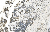IHC staining of FFPE human ovarian cancer with Isocitrate Dehydrogenase 2 antibody. HIER: boil tissue sections in pH8 EDTA for 20 min and allow to cool before testing.