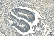 IHC staining of FFPE human rectal cancer with Isocitrate Dehydrogenase 2 antibody. HIER: boil tissue sections in pH8 EDTA for 20 min and allow to cool before testing.