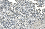 IHC staining of FFPE human testicular cancer with Isocitrate Dehydrogenase 2 antibody. HIER: boil tissue sections in pH8 EDTA for 20 min and allow to cool before testing.