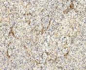 IHC staining of FFPE human adrenocortical adenoma tissue with FLNA antibody. HIER: boil tissue sections in pH8 EDTA for 20 min and allow to cool before testing.