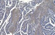 IHC staining of FFPE human rectal cancer with FLNA antibody. HIER: boil tissue sections in pH8 EDTA for 20 min and allow to cool before testing.