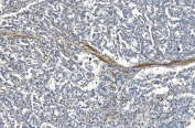 IHC staining of FFPE human melanoma with FLNA antibody. HIER: boil tissue sections in pH8 EDTA for 20 min and allow to cool before testing.