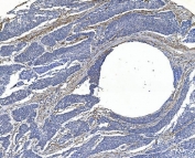 IHC staining of FFPE human esophageal squamous carcinoma with FLNA antibody. HIER: boil tissue sections in pH8 EDTA for 20 min and allow to cool before testing.